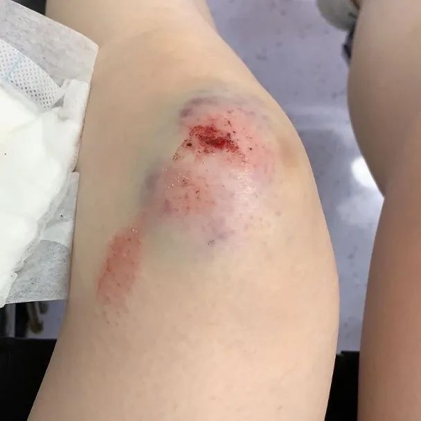 阿科罗纳队员受膝盖伤势困扰，将缺席数场比赛